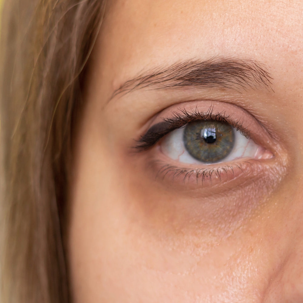 Eye Puffiness