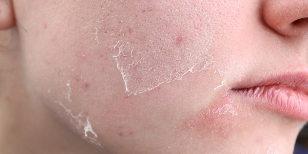 Close-up of dry skin patches on a cheek with a flaky paint appearance.