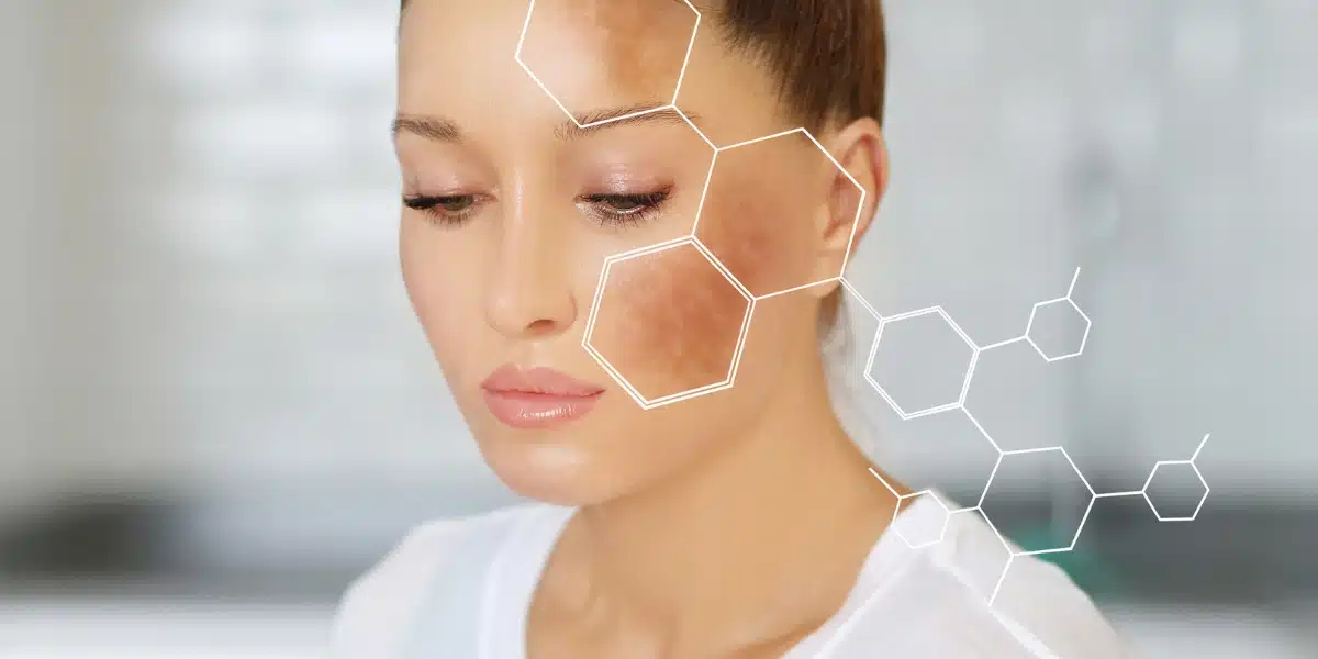 Close-up of a woman with dark spots on her face, illustrating natural remedies for dark spots.