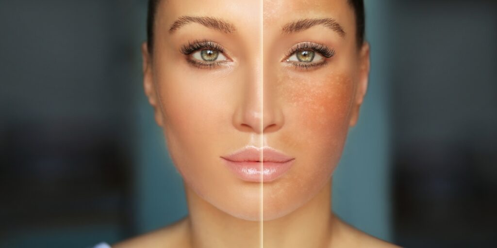 Close-up of a woman's face showing before and after effects of natural treatments to reduce melanin for even skin tone.