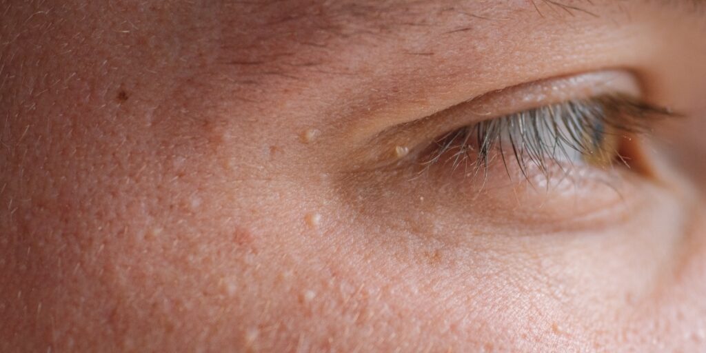 Close-up of milia bumps on facial skin, showcasing different sizes and textures.