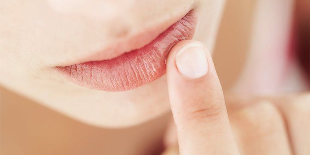 Close-up of lips showing dryness, cracks, and flakiness. Learn about dry lips causes and effective solutions for cracked bleeding lips.