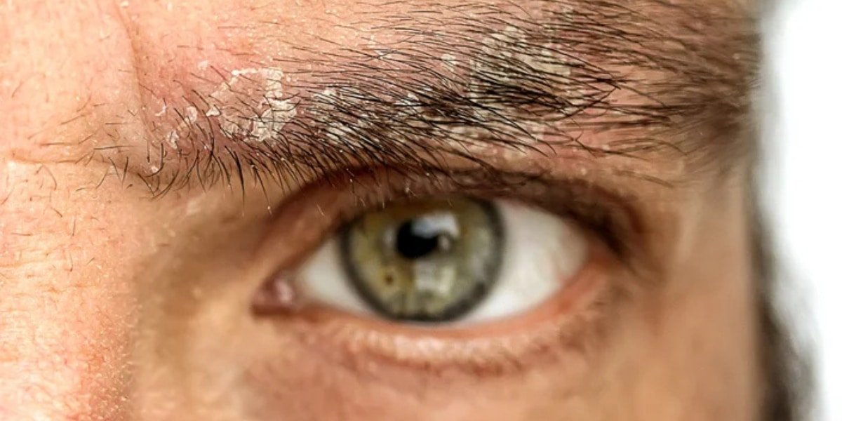 Close-up image showing eyebrow dandruff causes and flaking skin near the eyebrows.