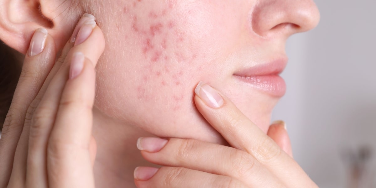 Close-up of a woman touching her cheek with hormonal acne, showcasing redness and scarring.